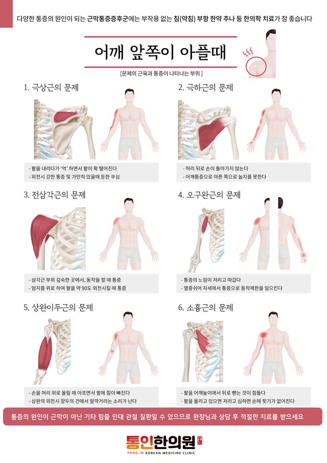 [근막통증증후군1]어깨앞쪽이 아플때(a4).jpg